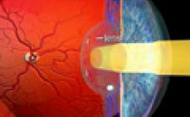 Diabetis: Causes and Prevention of Diabetic Retinopathy